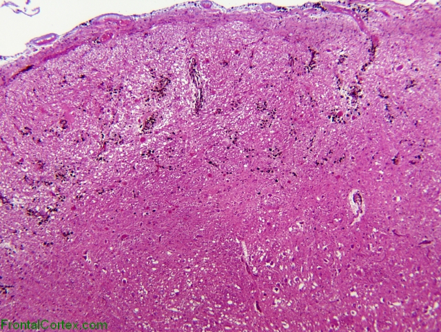superficial Siderosis, H&E stained section of medulla x 40